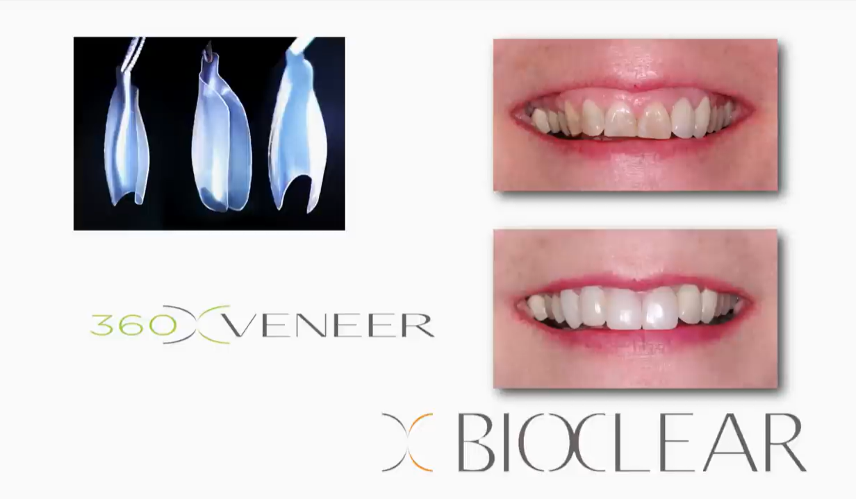 360° Veneer Matrix Series-12ct