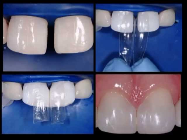 바이오클리어 매트릭스 전치부 리필 (25ct)