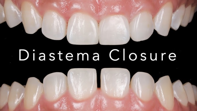 바이오클리어 매트릭스 전치부 리필 (25ct)