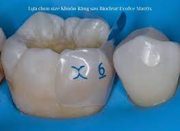 Bioclear Evolve Posterior Matrix