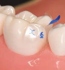 Bioclear Evolve Posterior Matrix